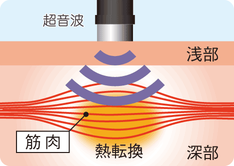 岐阜市やながせ整骨院では筋肉や関節の血流改善に超音波治療を行います
