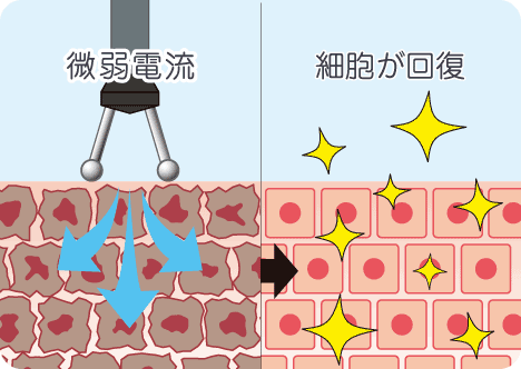 微弱電流治療は傷んだ細胞の回復を促進します