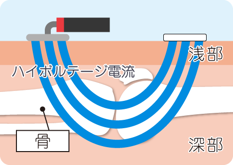 岐阜市やながせ整骨院の深部の痛みにハイボルテージ治療を行います